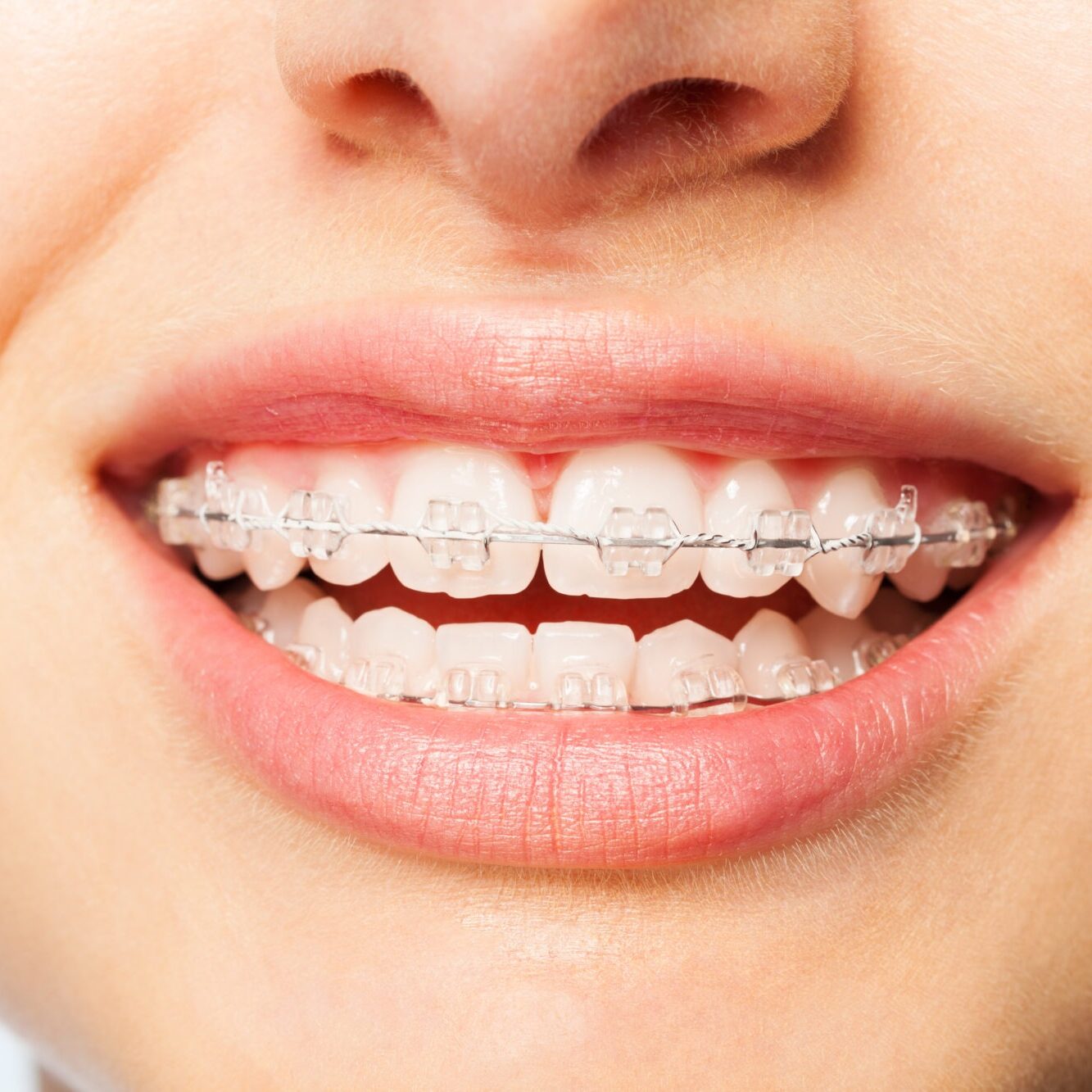 Healthy,Smile,Woman,With,Clear,Brackets